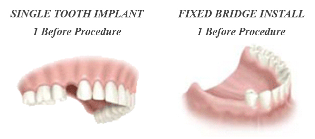 The Dental Implant Process